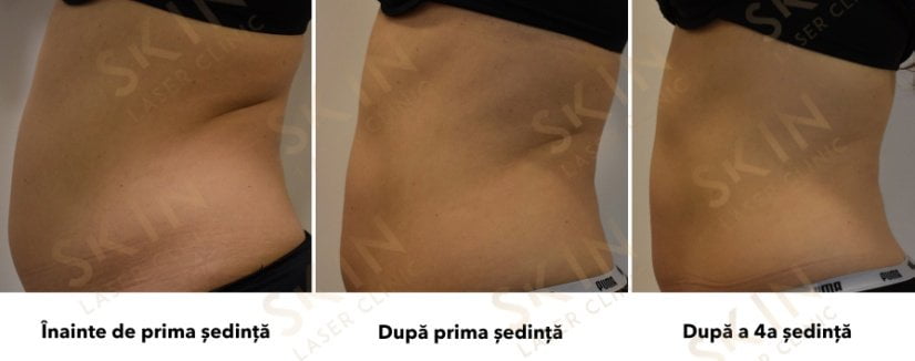 rezultate-slabire-brasov-remodelare-velashape3-skin-laser-clinic