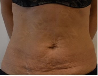 rezultate-slabire-brasov-remodelare-velashape3-skin-laser-clinic