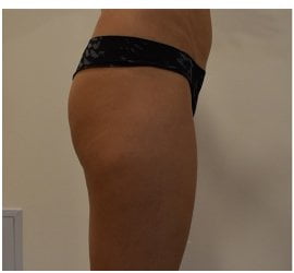 rezultate-slabire-brasov-remodelare-velashape3-skin-laser-clinic